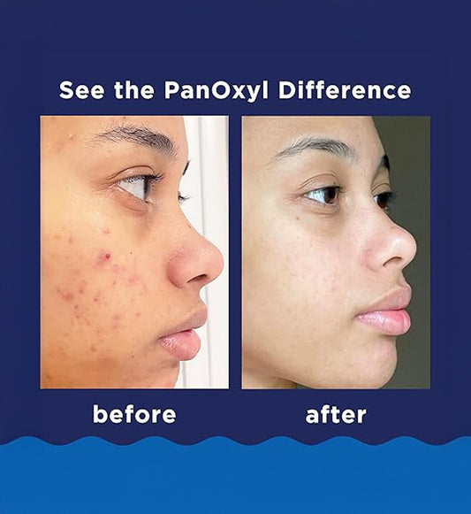Panoxyl Benzoyl Peroxide 10% Acne Foaming Wash